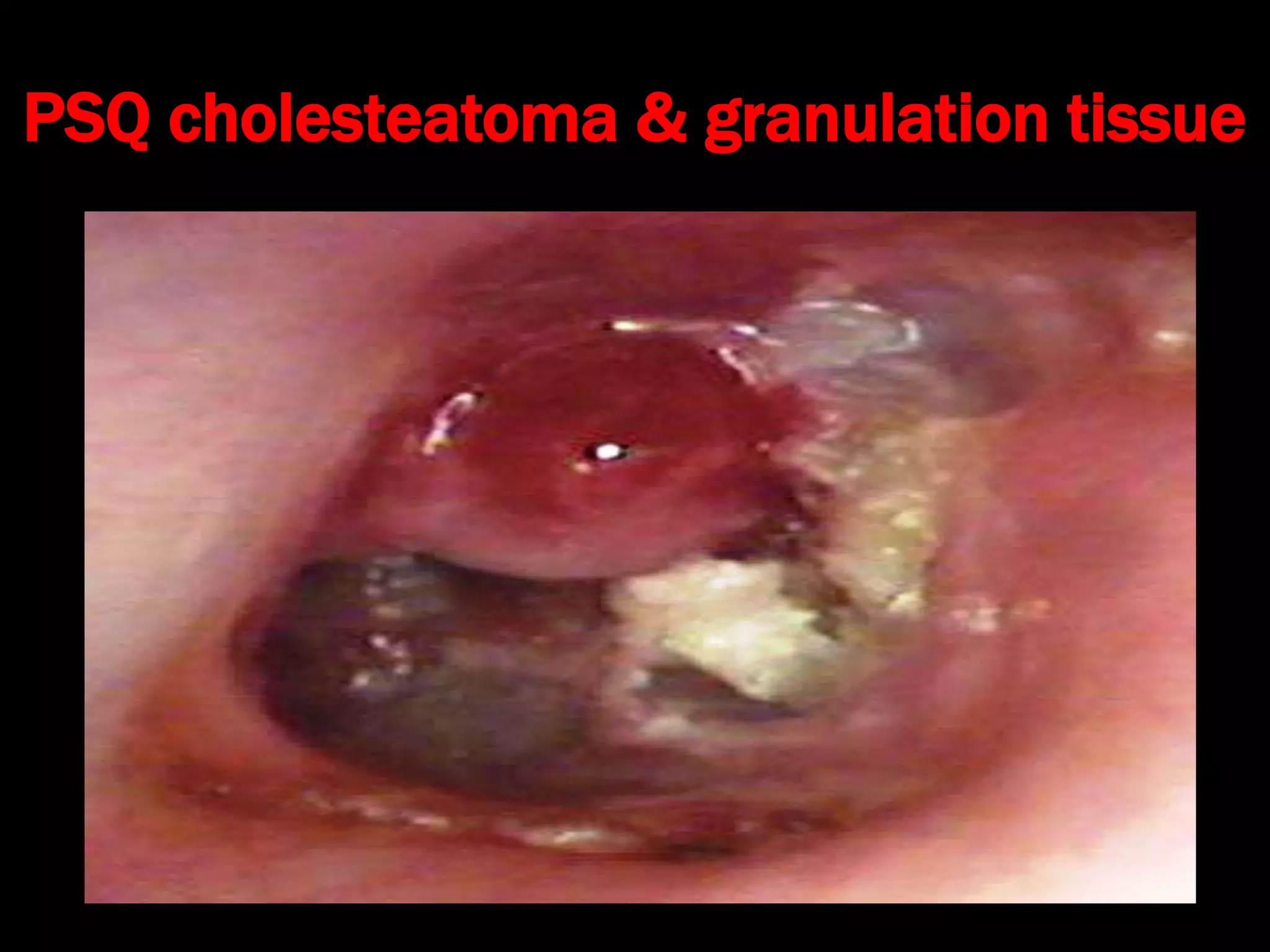 PSQ cholesteatoma & granulation tissue
 