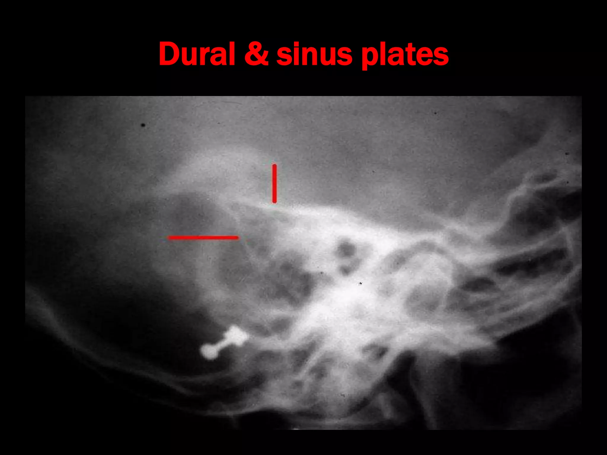 Dural & sinus plates
 
