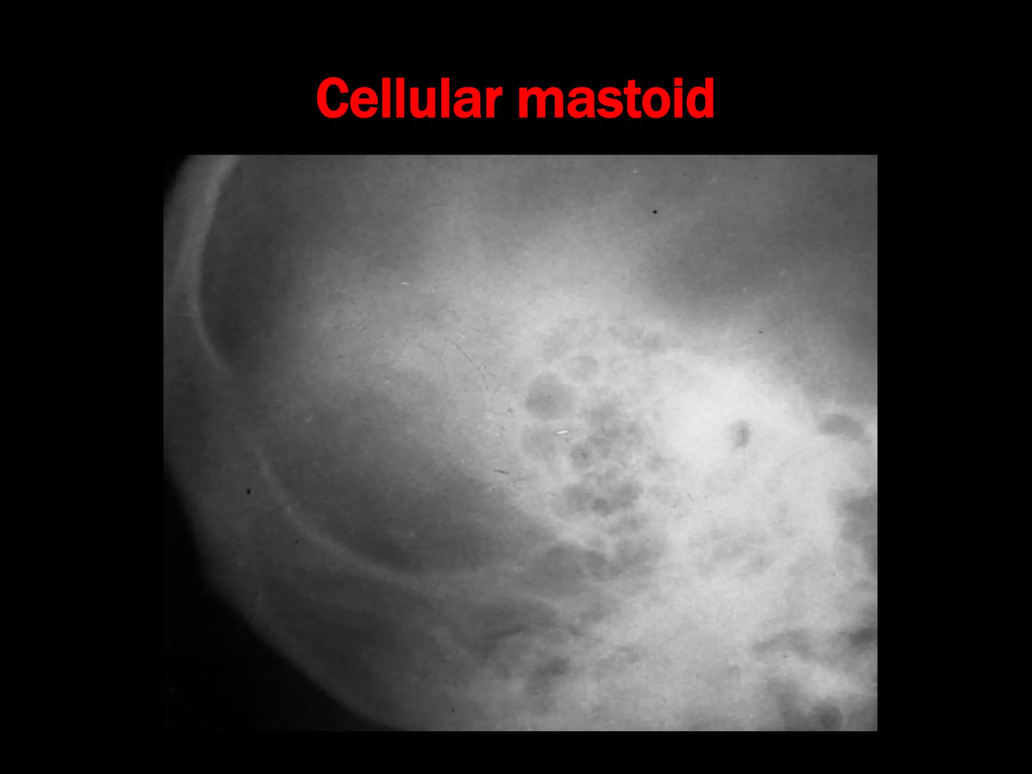 Cellular mastoid
 