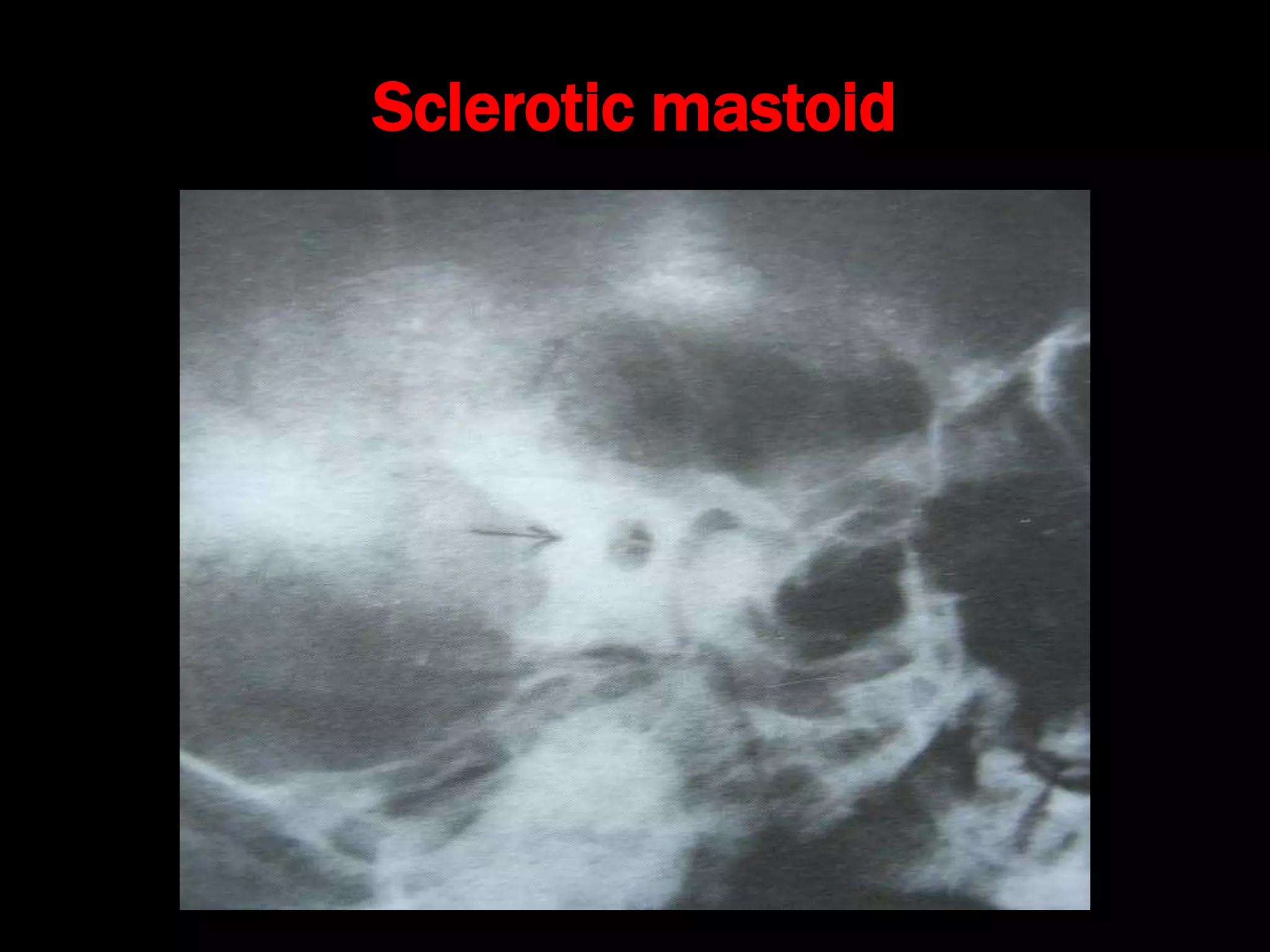Sclerotic mastoid
 