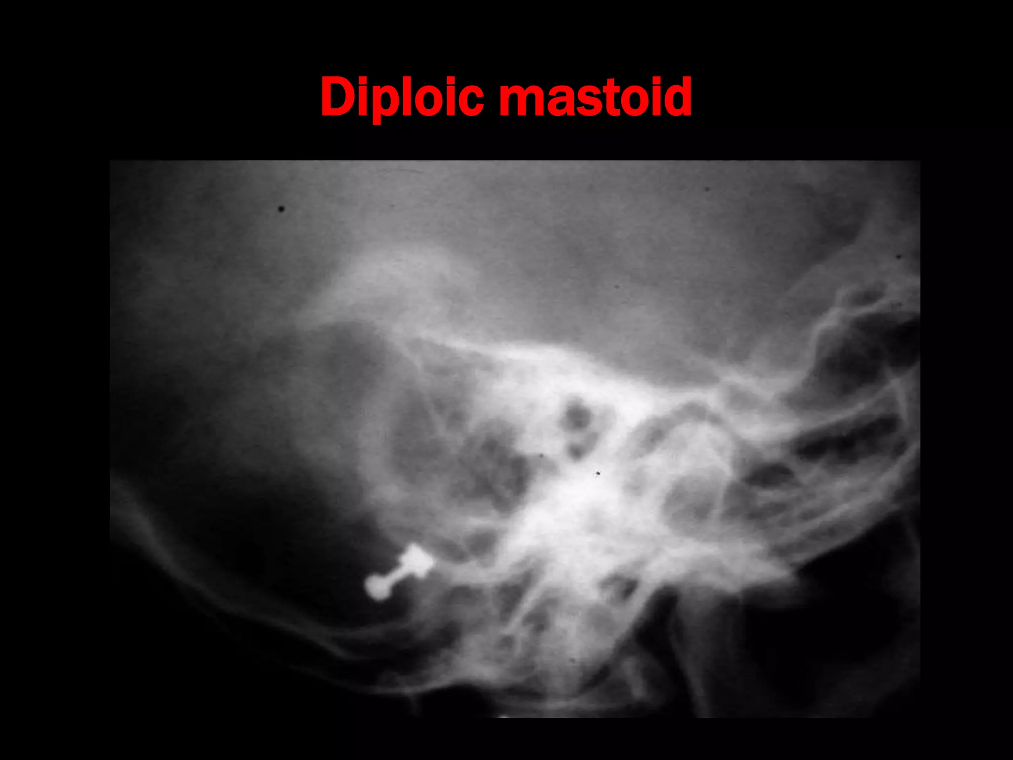 Diploic mastoid
 