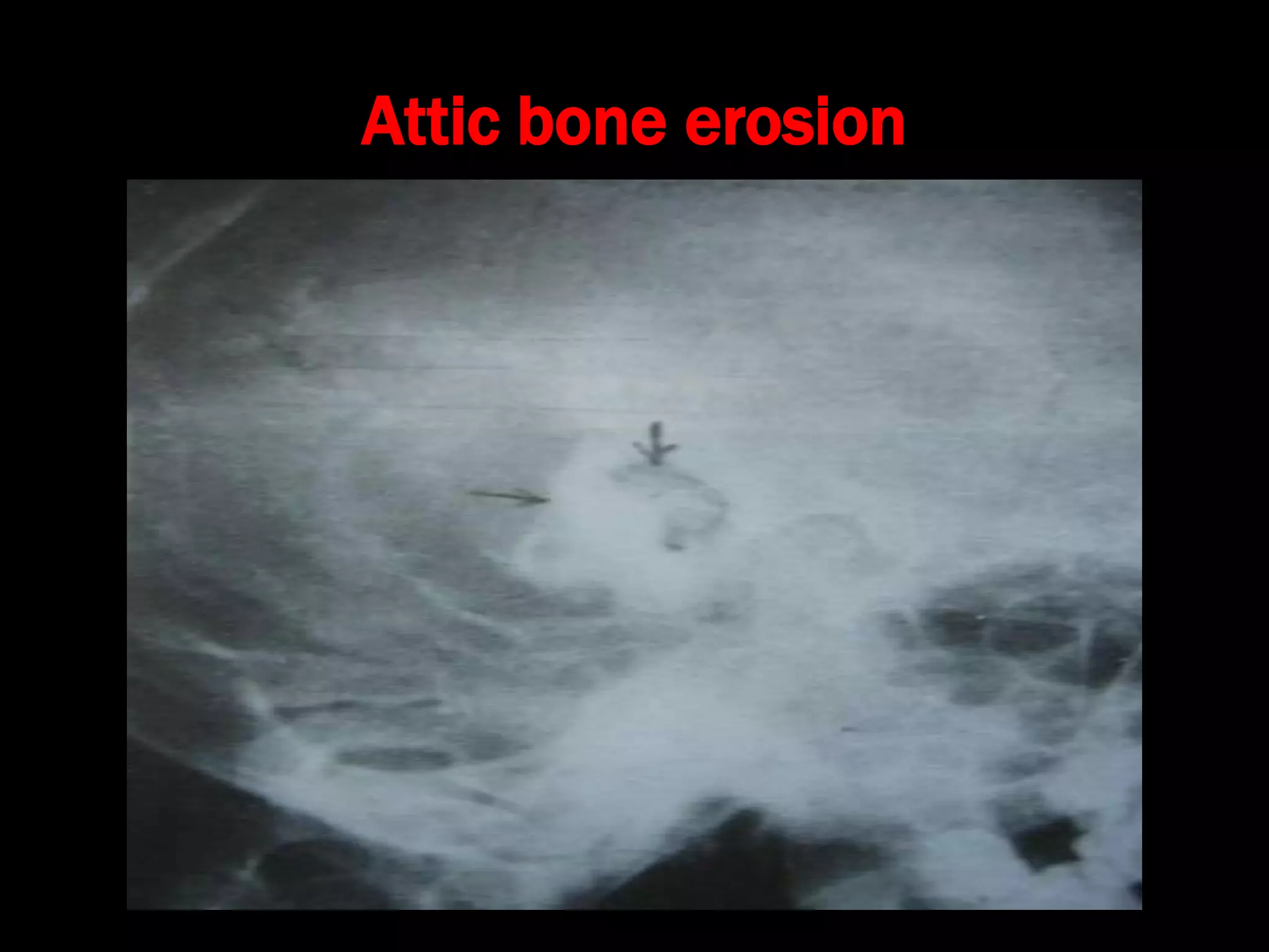 Attic bone erosion
 