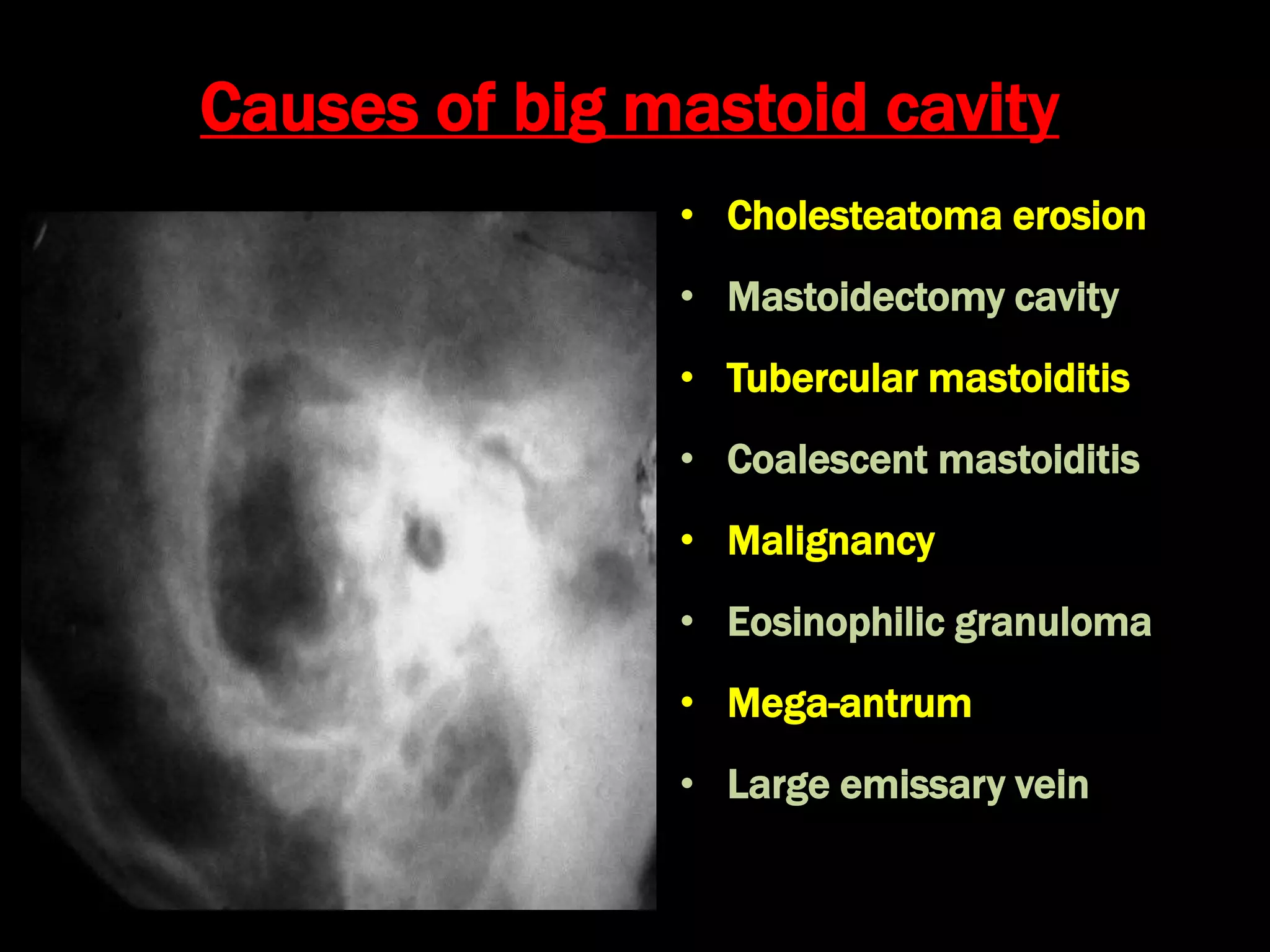 Causes of big mastoid cavity
• Cholesteatoma erosion
• Mastoidectomy cavity
• Tubercular mastoiditis
• Coalescent mastoiditis
• Malignancy
• Eosinophilic granuloma
• Mega-antrum
• Large emissary vein
 