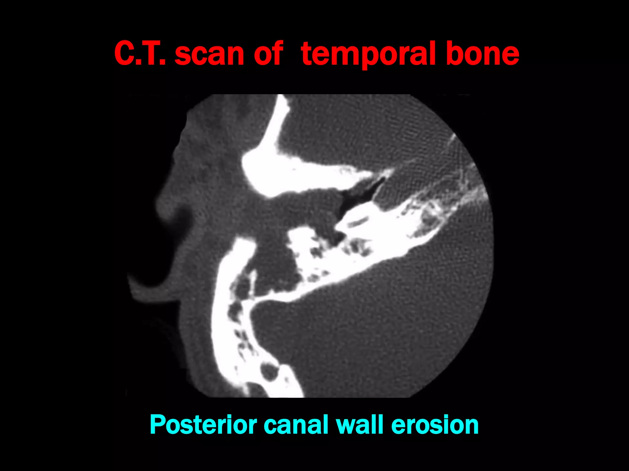 C.T. scan of temporal bone
Posterior canal wall erosion
 