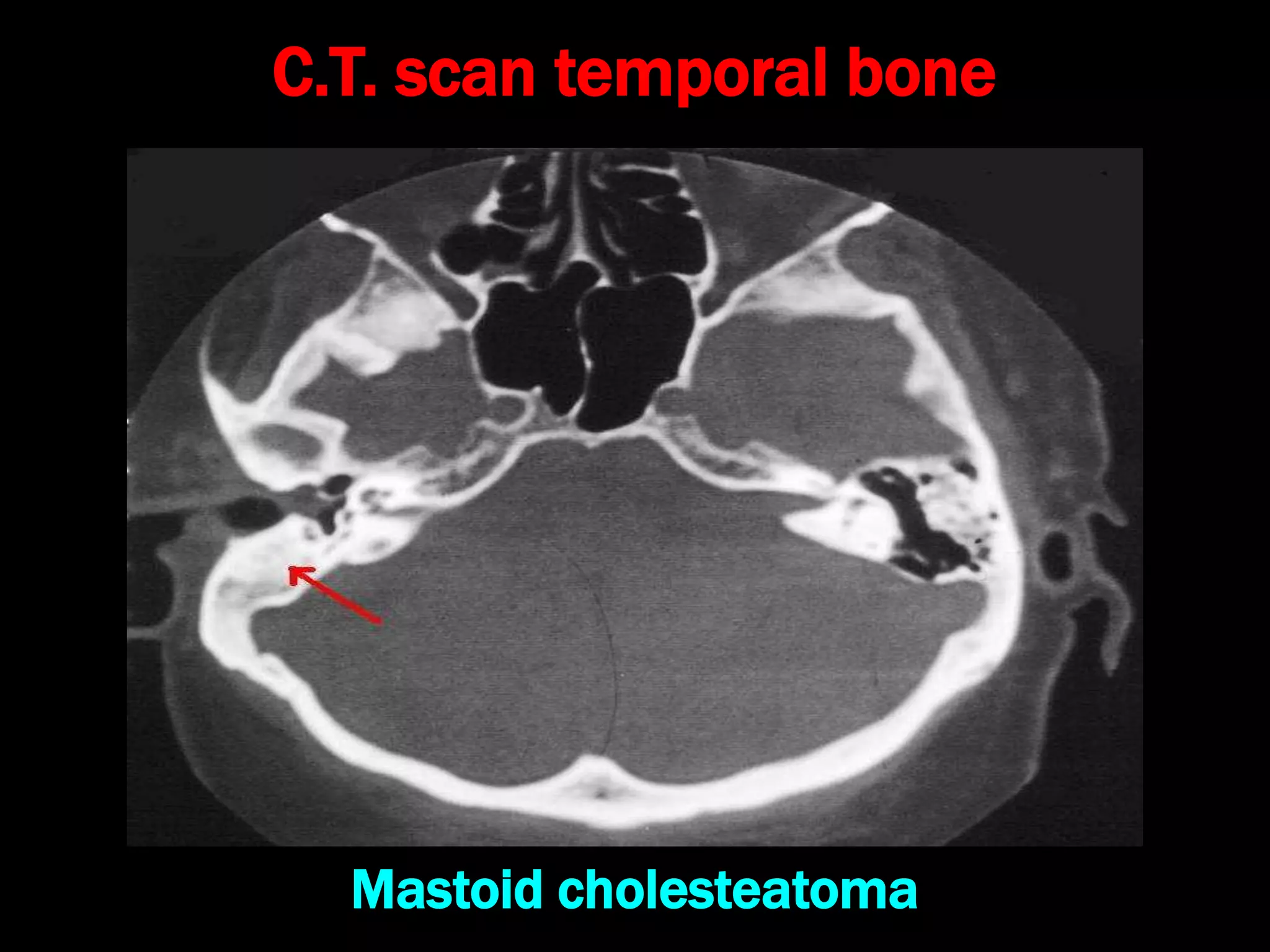 C.T. scan temporal bone
Mastoid cholesteatoma
 