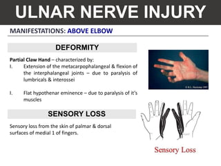 MANIFESTATIONS: ABOVE ELBOW
ULNAR NERVE INJURY
Partial Claw Hand – characterized by:
I. Extension of the metacarpophalangeal & flexion of
the interphalangeal joints – due to paralysis of
lumbricals & interossei
I. Flat hypothenar eminence – due to paralysis of it’s
muscles
Sensory loss from the skin of palmar & dorsal
surfaces of medial 1 of fingers.
DEFORMITY
SENSORY LOSS
 