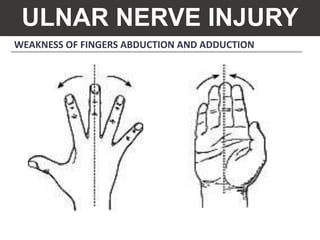 WEAKNESS OF FINGERS ABDUCTION AND ADDUCTION
ULNAR NERVE INJURY
 