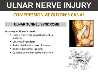 COMPRESSION AT GUYON’S CANAL
ULNAR NERVE INJURY
Anatomy of Guyon’s canal :
 Floor = transverse carpal ligament to
pisiform
 Ulnar wall = pisiform
 Radial distal wall = hook of hamate
 Roof = volar carpal ligament
 Contains only ulnar nerve and artery
ULNAR TUNNEL SYNDROME
 