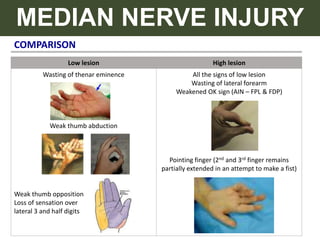 COMPARISON
MEDIAN NERVE INJURY
Low lesion High lesion
Wasting of thenar eminence
Weak thumb abduction
Weak thumb opposition
Loss of sensation over
lateral 3 and half digits
All the signs of low lesion
Wasting of lateral forearm
Weakened OK sign (AIN – FPL & FDP)
Pointing finger (2nd and 3rd finger remains
partially extended in an attempt to make a fist)
 