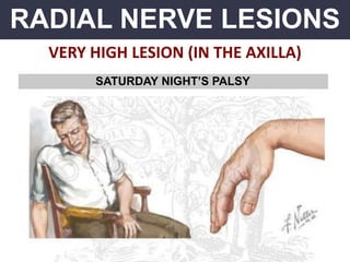 RADIAL NERVE LESIONS
VERY HIGH LESION (IN THE AXILLA)
SATURDAY NIGHT’S PALSY
 