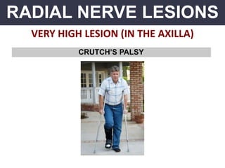 RADIAL NERVE LESIONS
VERY HIGH LESION (IN THE AXILLA)
CRUTCH’S PALSY
 