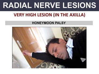 RADIAL NERVE LESIONS
VERY HIGH LESION (IN THE AXILLA)
HONEYMOON PALSY
 