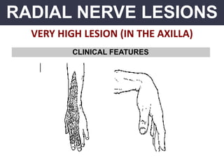 RADIAL NERVE LESIONS
VERY HIGH LESION (IN THE AXILLA)
CLINICAL FEATURES
 