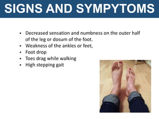  Decreased sensation and numbness on the outer half
of the leg or dosum of the foot.
 Weakness of the ankles or feet,
 Foot drop
 Toes drag while walking
 High stepping gait
SIGNS AND SYMPYTOMS
 