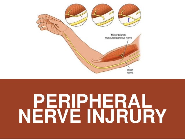 Peripheral nerve injuries Peripheral nerve injuries