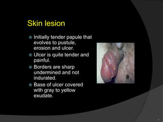 Skin lesion
 Initially tender papule that
evolves to pustule,
erosion and ulcer.
 Ulcer is quite tender and
painful.
 Borders are sharp
undermined and not
indurated.
 Base of ulcer covered
with gray to yellow
exudate.
4
 