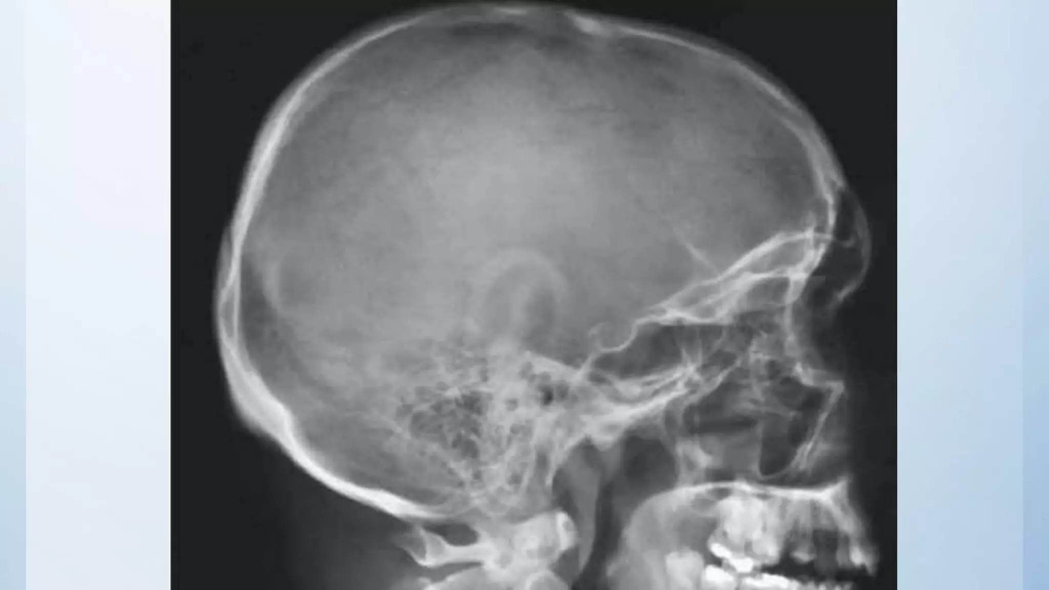 Radiographic Anatomy of the Head and Neck | PPTX