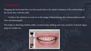 D. Smile analysis:
Dragging the horizontal line over the mouth allows for initial evaluation of the relationship of
the facial lines with the smile.
It allows the clinician to zoom in on the image without loosing the reference between the
lines and photograph.
This helps in detecting midline shifts, occlusal plane shifting and cants, position of incisal edges,
gingival zeniths etc.
 
