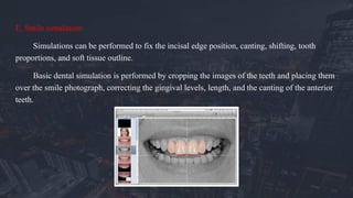 E. Smile simulation:
Simulations can be performed to fix the incisal edge position, canting, shifting, tooth
proportions, and soft tissue outline.
Basic dental simulation is performed by cropping the images of the teeth and placing them
over the smile photograph, correcting the gingival levels, length, and the canting of the anterior
teeth.
 