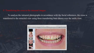 F. Transferring the cross to the intraoral images:
To analyze the intraoral photographs in accordance with the facial references, the cross is
transferred to the retracted view using three transferring lines drawn over the smile view.
 
