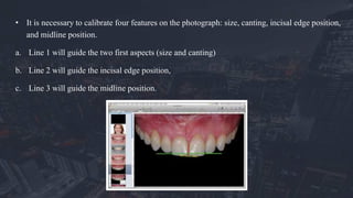 • It is necessary to calibrate four features on the photograph: size, canting, incisal edge position,
and midline position.
a. Line 1 will guide the two first aspects (size and canting)
b. Line 2 will guide the incisal edge position,
c. Line 3 will guide the midline position.
 