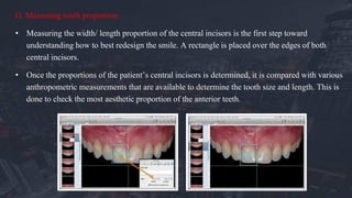 G. Measuring tooth proportion:
• Measuring the width/ length proportion of the central incisors is the first step toward
understanding how to best redesign the smile. A rectangle is placed over the edges of both
central incisors.
• Once the proportions of the patient’s central incisors is determined, it is compared with various
anthropometric measurements that are available to determine the tooth size and length. This is
done to check the most aesthetic proportion of the anterior teeth.
 