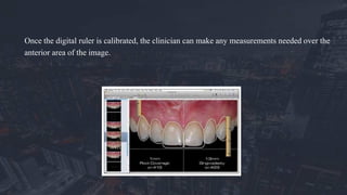 Once the digital ruler is calibrated, the clinician can make any measurements needed over the
anterior area of the image.
 