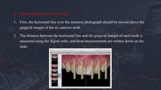 K. Transferring the cross to the cast:
1. First, the horizontal line over the intraoral photograph should be moved above the
gingival margin of the six anterior teeth.
2. The distance between the horizontal line and the gingival margin of each tooth is
measured using the digital ruler, and these measurements are written down on the
slide.
 