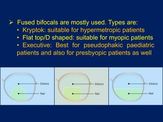  Fused bifocals are mostly used. Types are:
• Kryptok: suitable for hypermetropic patients
• Flat top/D shaped: suitable for myopic patients
• Executive: Best for pseudophakic paediatric
patients and also for presbyopic patients as well
 