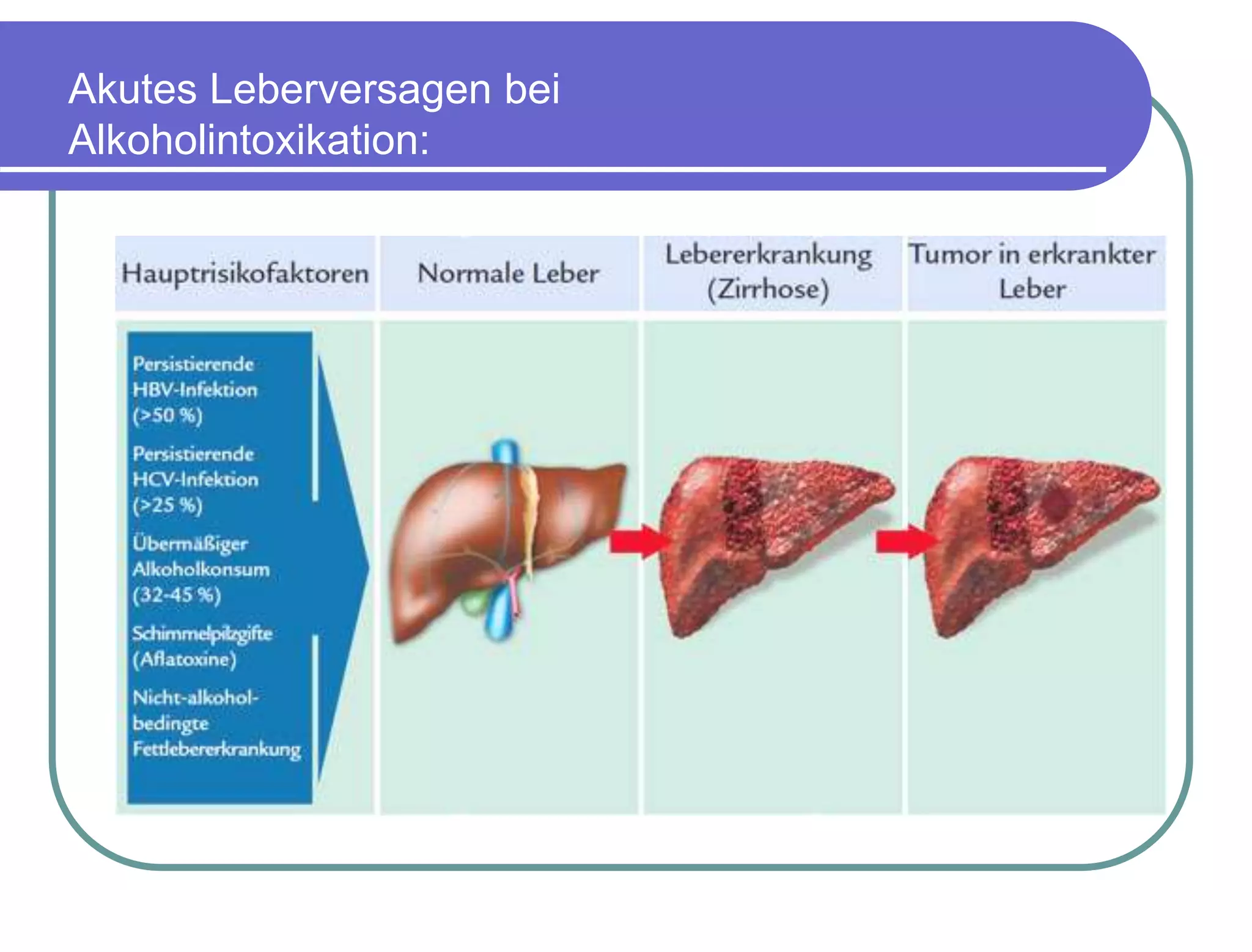 15.101 Akutes Leberversagen bei Leberschäden und Vergiftung.
