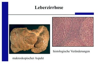 Medizinische Klinik III, UKA, RWTH Aachen
makroskopischer Aspekt
histologische Veränderungen
Leberzirrhose
 