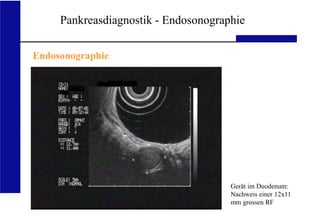 UKA Medizinische Klinik III RWTH Aachen
Pankreasdiagnostik - Endosonographie
Endosonographie
Gerät im Duodenum:
Nachweis einer 12x11
mm grossen RF
 