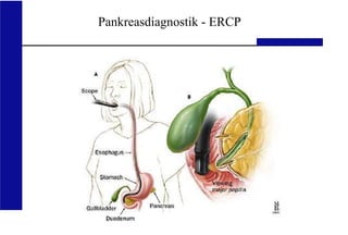 UKA Medizinische Klinik III RWTH Aachen
Pankreasdiagnostik - ERCP
 