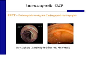 UKA Medizinische Klinik III RWTH Aachen
Pankreasdiagnostik - ERCP
Endoskopische Darstellung der Minor- und Majorpapille
ERCP – Endoskopische retrograde Cholangiopankreaticographie
 