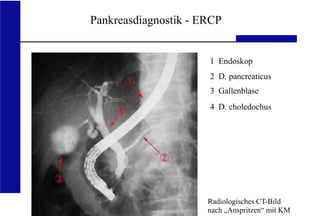 UKA Medizinische Klinik III RWTH Aachen
Pankreasdiagnostik - ERCP
1 Endoskop
2 D. pancreaticus
3 Gallenblase
4 D. choledochus
Radiologisches CT-Bild
nach „Anspritzen“ mit KM
 