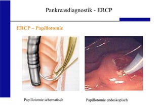 UKA Medizinische Klinik III RWTH Aachen
Pankreasdiagnostik - ERCP
ERCP – Papillotomie
Papillotomie schematisch Papillotomie endoskopisch
 
