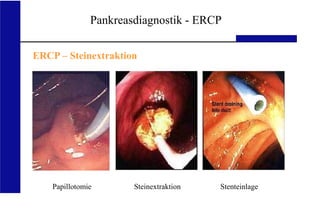 UKA Medizinische Klinik III RWTH Aachen
Pankreasdiagnostik - ERCP
ERCP – Steinextraktion
Papillotomie Steinextraktion Stenteinlage
 
