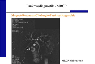 UKA Medizinische Klinik III RWTH Aachen
Pankreasdiagnostik - MRCP
Magnet-Resonanz-Cholangio-Pankreaticographie
MRCP: Gallensteine
 