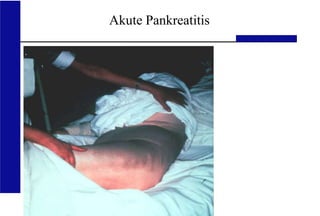 UKA Medizinische Klinik III RWTH Aachen
Akute Pankreatitis
 