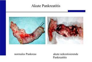 UKA Medizinische Klinik III RWTH Aachen
Akute Pankreatitis
normales Pankreas akute nekrotisierende
Pankreatitis
 
