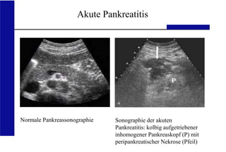 UKA Medizinische Klinik III RWTH Aachen
Akute Pankreatitis
Normale Pankreassonographie Sonographie der akuten
Pankreatitis: kolbig aufgetriebener
inhomogener Pankreaskopf (P) mit
peripankreatischer Nekrose (Pfeil)
 