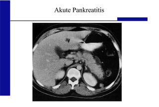 UKA Medizinische Klinik III RWTH Aachen
Akute Pankreatitis
 