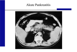 UKA Medizinische Klinik III RWTH Aachen
Akute Pankreatitis
 