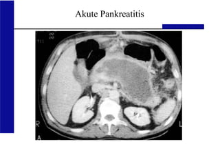 UKA Medizinische Klinik III RWTH Aachen
Akute Pankreatitis
 