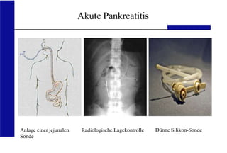 UKA Medizinische Klinik III RWTH Aachen
Akute Pankreatitis
Anlage einer jejunalen
Sonde
Radiologische Lagekontrolle Dünne Silikon-Sonde
 