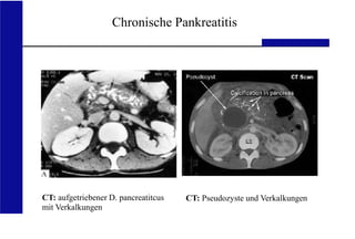 UKA Medizinische Klinik III RWTH Aachen
Chronische Pankreatitis
CT: aufgetriebener D. pancreatitcus
mit Verkalkungen
CT: Pseudozyste und Verkalkungen
 