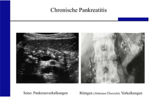 UKA Medizinische Klinik III, RWTH Aachen
Chronische Pankreatitis
Sono: Pankreasverkalkungen Röntgen (Abdomen-Übersicht): Verkalkungen
 