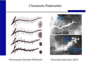 UKA Medizinische Klinik III RWTH Aachen
Chronische Pankreatitis
Schweregrade chronische Pankreatitis Chronische Pankreatitis: ERCP
 