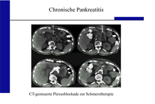 UKA Medizinische Klinik III RWTH Aachen
CT-gesteuerte Plexusblockade zur Schmerztherapie
Chronische Pankreatitis
 