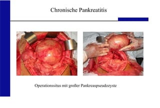 UKA Medizinische Klinik III RWTH Aachen
Chronische Pankreatitis
Operationssitus mit großer Pankreaspseudozyste
 